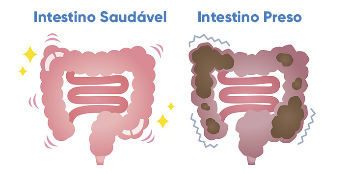 O que e prisao de ventre intestino preso